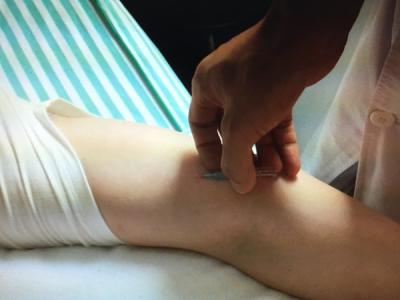 梅花针三棱针,三棱针常用针法