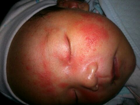 婴儿湿疹已经消了但又变得很红,宝宝湿疹好了以后皮肤会变黑