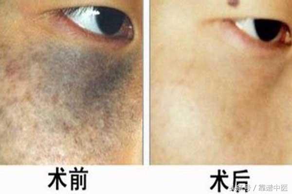 脸上黑斑是怎么造成的,脸上黑斑是怎样形成的