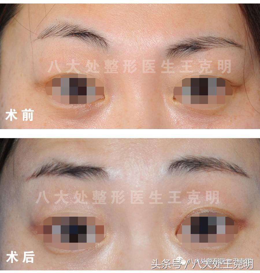 高低眉眼睛怎么改善,高低眉最简单的恢复方法