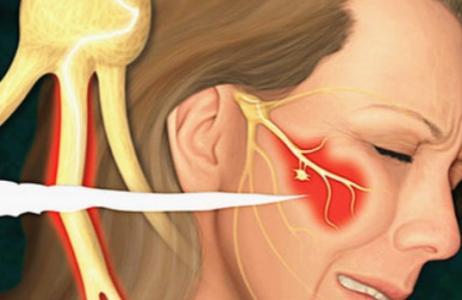 肿瘤压迫的三叉神经痛应该怎么样,三叉神经痛肿瘤会有什么症状