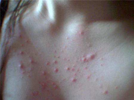 女人湿气太重了皮肤发痒怎么办,女人湿气太重喝什么茶快速祛湿