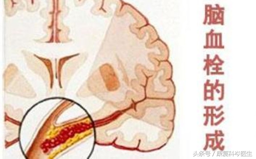 脑血栓治愈后还会复发吗,脑血栓血管堵塞还能再通吗