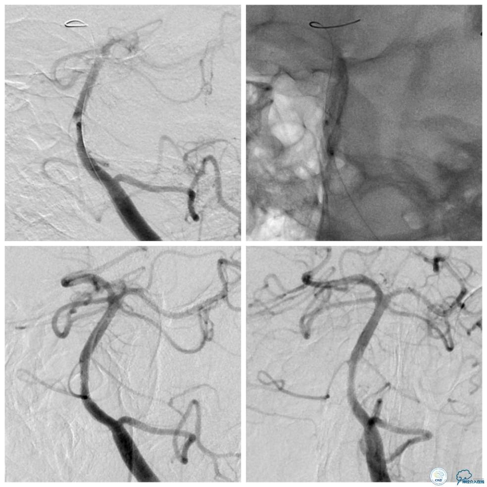 天坛医院基底动脉,天坛医院脑血管支架费用高吗