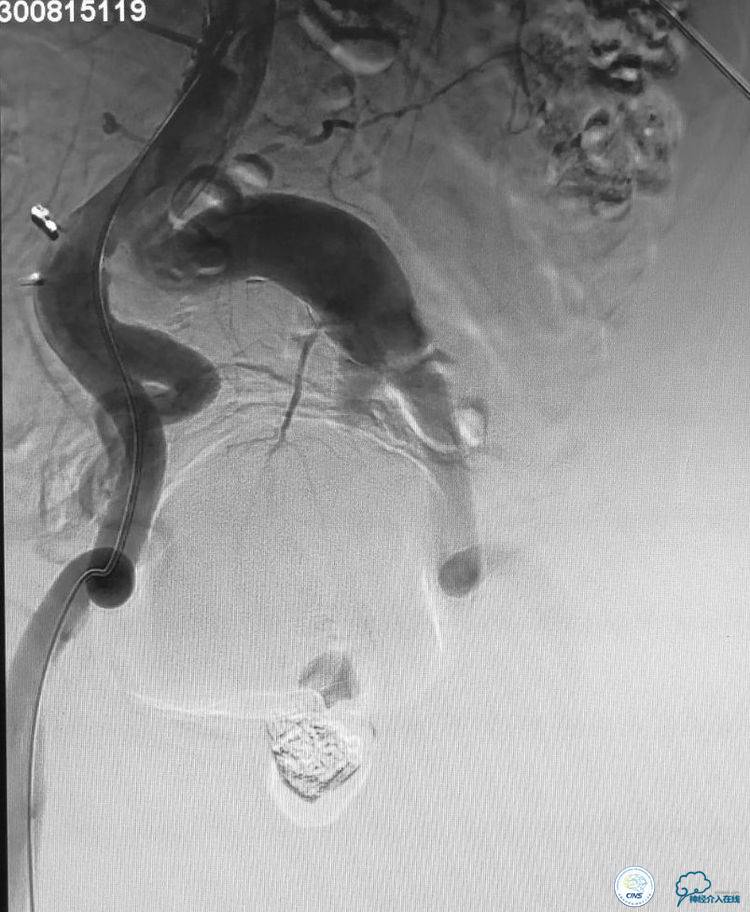 支架辅助弹簧圈栓塞治疗狭窄伴复杂动脉瘤