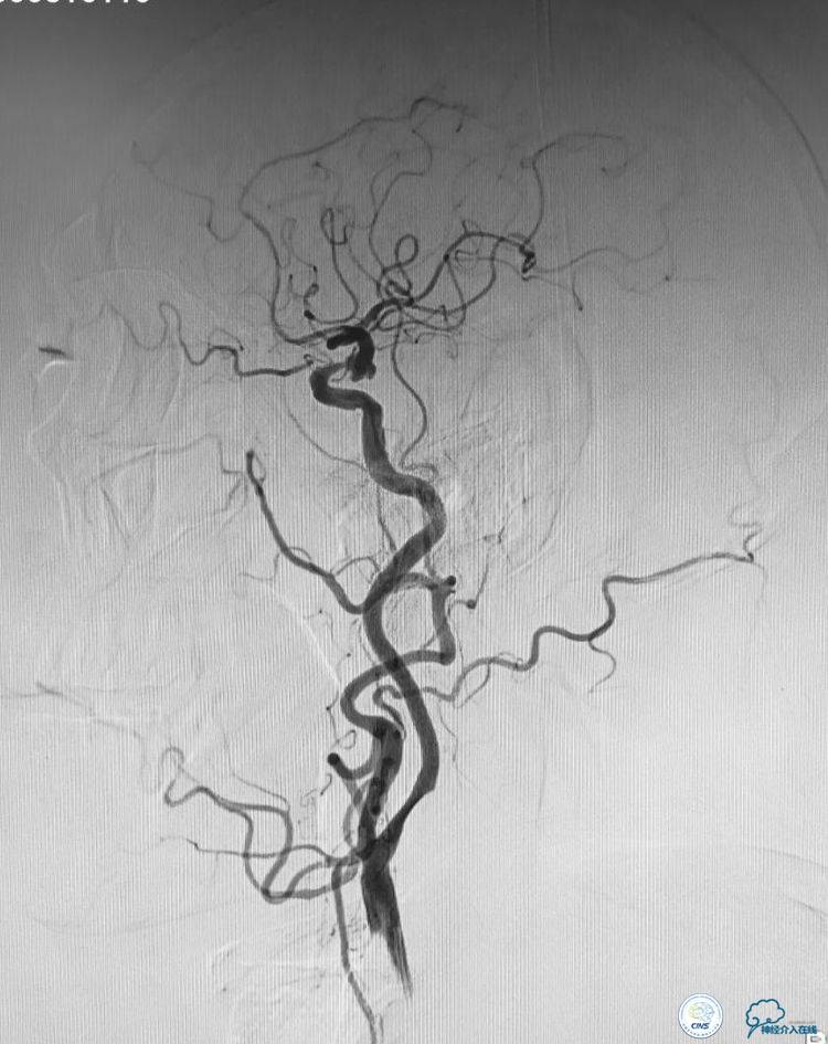 支架辅助弹簧圈栓塞治疗狭窄伴复杂动脉瘤