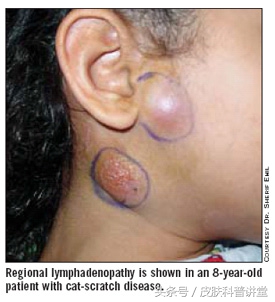 有没有被猫抓过,那你可要留意一下这个皮肤病了,猫抓病