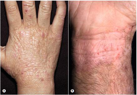 孩子湿疹吃什么药,8岁孩子湿疹