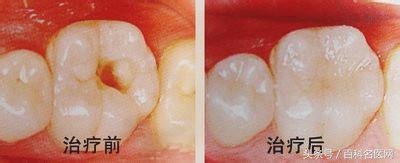 牙洞是什么原因造成的,牙洞有什么危害