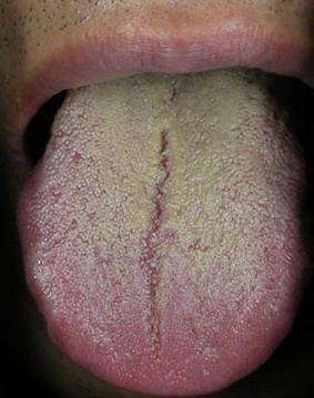 湿气重的5大信号你读懂了吗,湿气重有5大信号