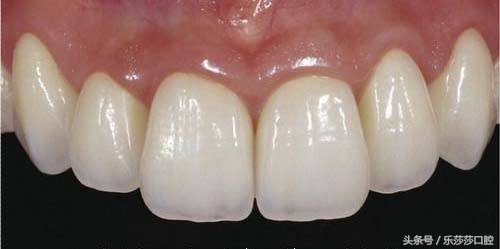 为什么牙医爱忽悠人做烤瓷牙,牙医的真相大全