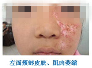 鲜红斑痣专家,鲜红斑痣一定要治疗吗