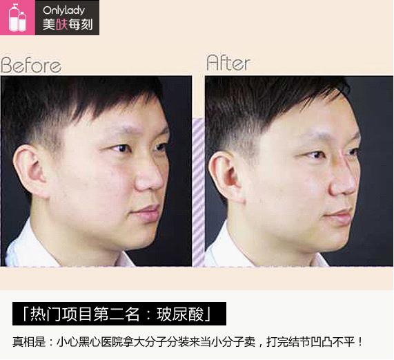 整形医生聊内幕瘦脸针,揭秘医美内幕水光针