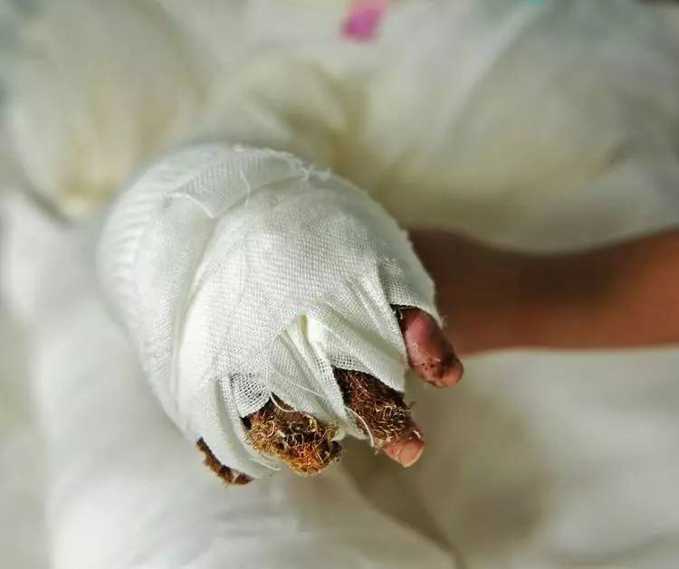 烫伤植皮男孩后续,好心人看望6岁烧伤男孩捐款10万元