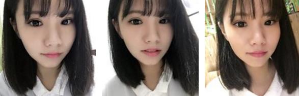 做双眼皮是如何打麻药的,其实做双眼皮没想象中那么疼