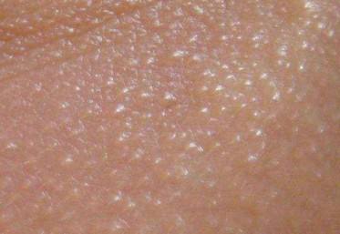 眼睛下边脂肪粒怎么去除小妙招,眼睛下边长了脂肪粒