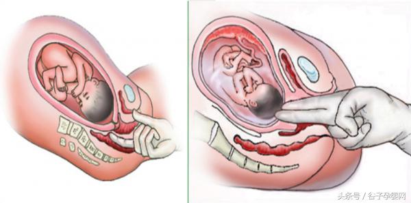 顺产自然分娩知识,自然分娩过程分为几个产程
