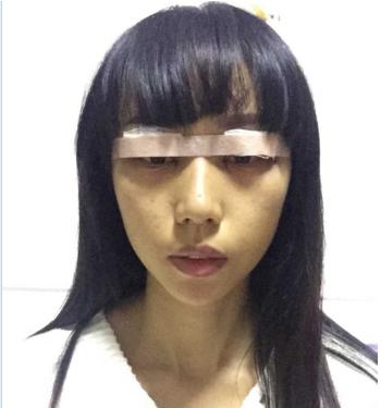 双眼皮割得太宽了怎么办,眼骨低割不了太宽的双眼皮