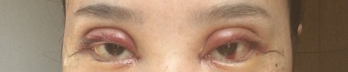 全切双眼皮疤痕增生多久可以恢复,全切双眼皮恢复过程经历真实