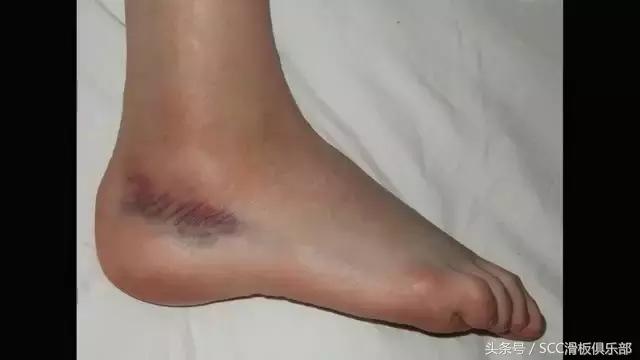 怎么快速恢复崴伤的脚踝,如何彻底治愈脚踝陈旧性扭伤