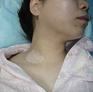 治疗白癜风期间可以怀孕吗,白癜风怀孕有什么症状