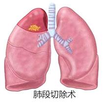 关于癌症你一定要知道的事,肺癌家属应该知道哪些问题