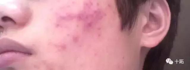 爱美的你，肯定不想脸上留下那么几个“青春印记”｜黄青说“美”