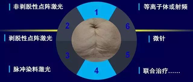 严重的膨胀纹怎么治疗,膨胀纹最好的治疗方法