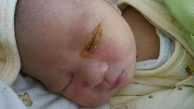 幼儿园急性结膜炎的预防小知识,结膜炎哺乳期宝妈如何用药