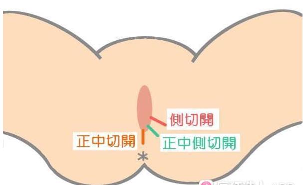 顺产下面撕裂缝合的线不拆可以吗,顺产剪一刀需要缝吗