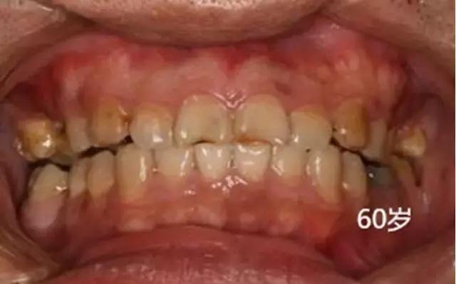 小孩开始换牙了,宝爸宝妈看过来你家宝贝换牙了吗