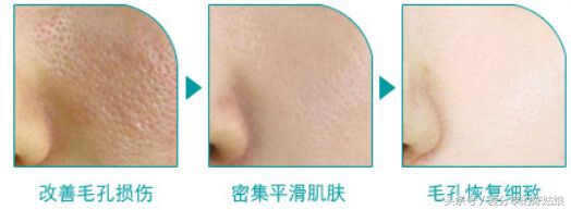 烫伤后毛孔变大会恢复正常吗,清洁毛孔后不收缩毛孔会变大吗
