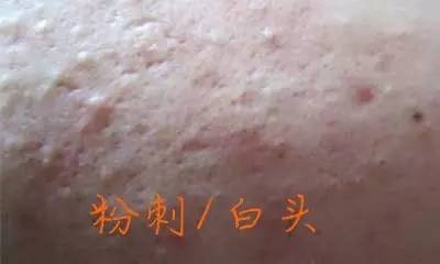 闭合性粉刺爆浆,闭合性粉刺还有痘印