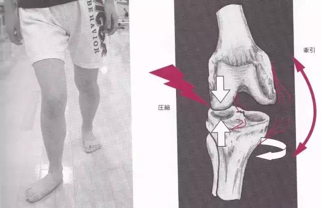 八字脚跑步对身体有什么影响,跑步怎么纠正外八字脚