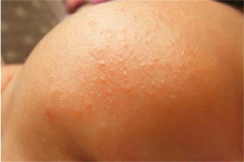 新生儿湿疹热疹宝妈要忌口吗,热痱子和湿疹荨麻疹有什么区别