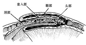 宝宝肠套叠的原因及解决方法,怎么缓解宝宝肠套叠肚子疼