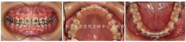 龅牙深覆合矫正效果,26岁了深覆合龅牙还能矫正吗