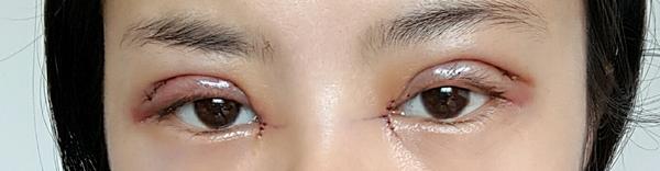 全切双眼皮15天,恢复的差不多了