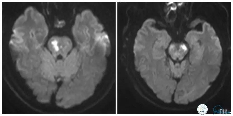 天坛周记|右椎动脉V1段及V4-基底动脉串联病变支架治疗一例