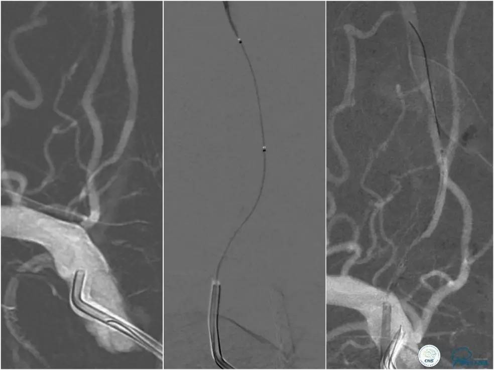 天坛周记|右椎动脉V1段及V4-基底动脉串联病变支架治疗一例
