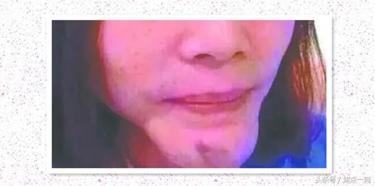 垫下巴之后感觉嘴扁,垫下巴垫歪了能用玻尿酸矫正吗