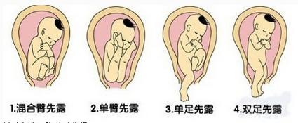 孕妇胎位不正医生使出乾坤大挪移,孕妇胎位不正医生手动转正胎位