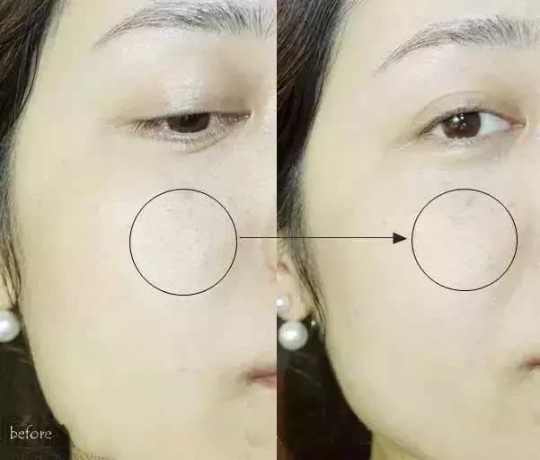 爆痘脱皮怎么快速解决,换季爆痘干燥