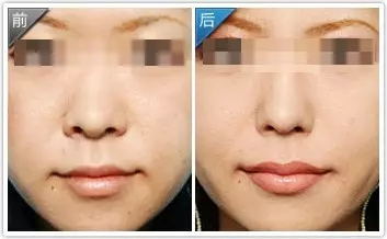 鼻部整形有哪些注意事项,鼻部整形一个月内能做剧烈运动吗