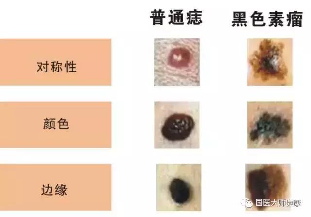 突然长出来的痣要切吗,乳房突然长痣会癌变吗