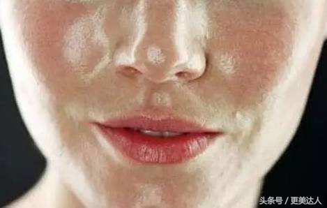 拯救脸部毛孔粗大,橘皮毛孔粗大改善方案