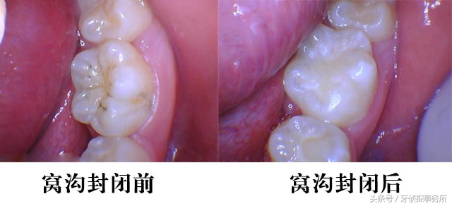 宝宝牙齿洞大怎么补救,牙齿窝沟深怎么回事