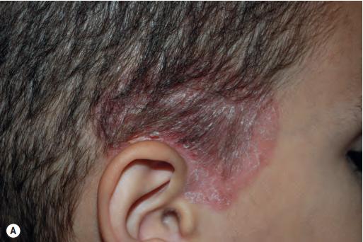 银屑病关节炎和银屑病区别,银屑病关节炎跟银屑病一样吗