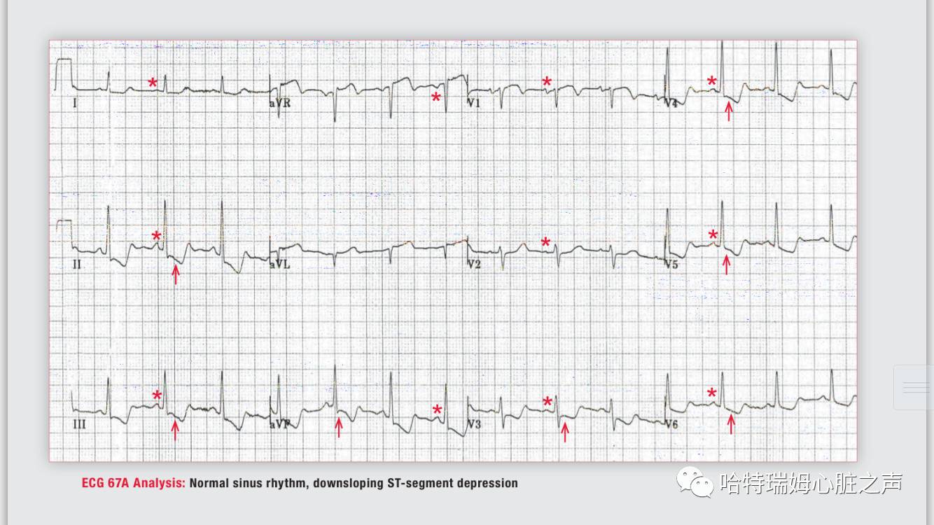 读心有术视频讲解,长期心电图提示下壁st段轻度压低