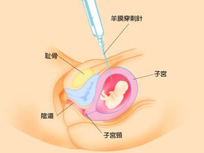 孕晚期羊水过少能顺产吗,孕晚期羊水深度多少能增加羊水